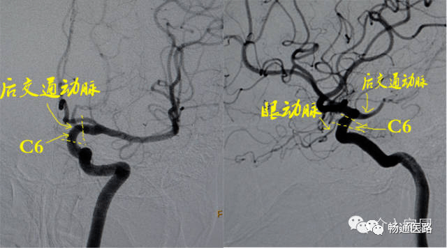 颈内动脉c6段在侧位脑血管造影显示最清楚, 在与c5段(床突段)交界处远