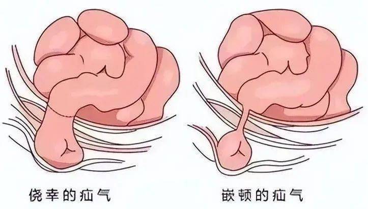 用疝气带治疗效果好吗?