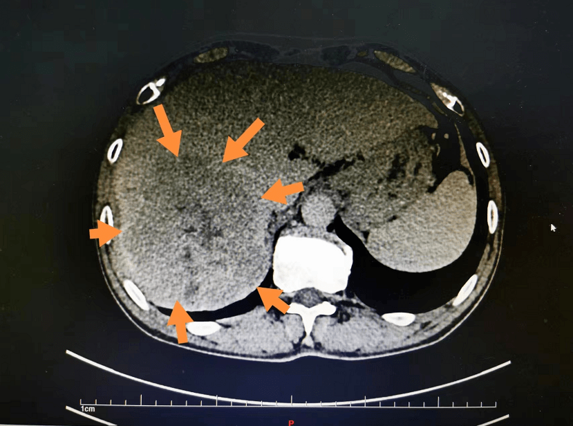 【友谊肝胆】妙手医生精准打击,完美切除巨块型肝癌_肝脏_王先生_肿瘤