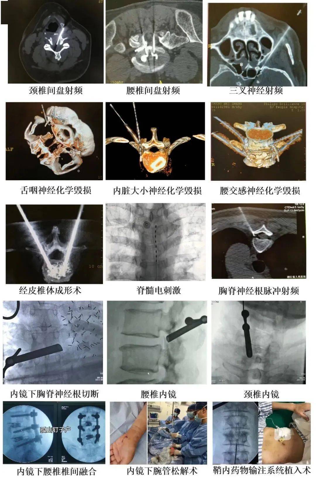 替加环素鞘内注射图片