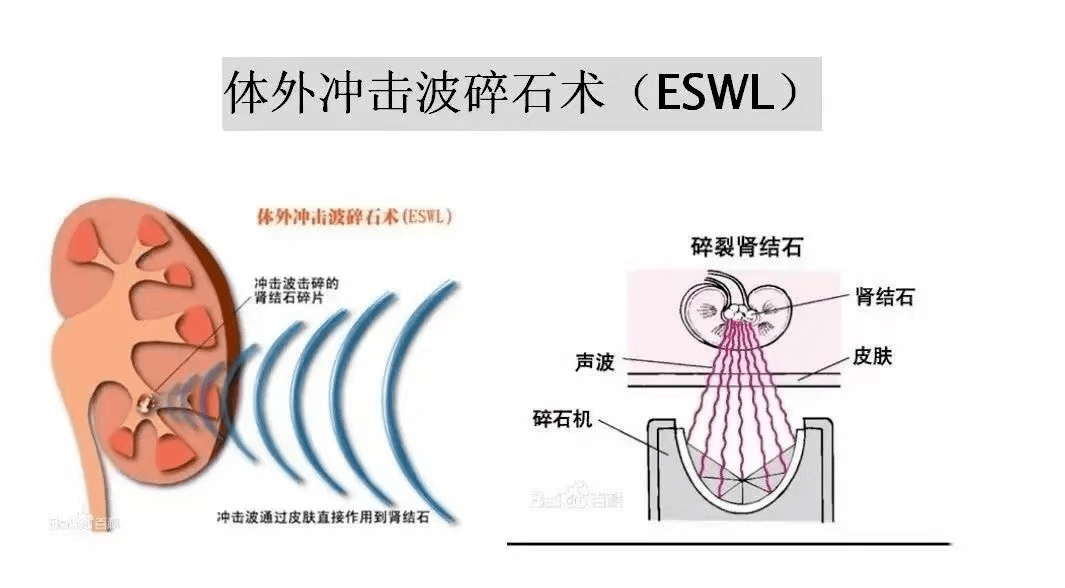 体外冲击波碎石,它是利用一种特殊的超声波,由机器聚焦后对准结石