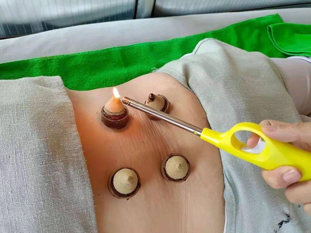 隔饼附子灸艾箱灸穴位埋线4.督灸 5.带脉灸 6.艾箱灸 7.聚能灸 8.