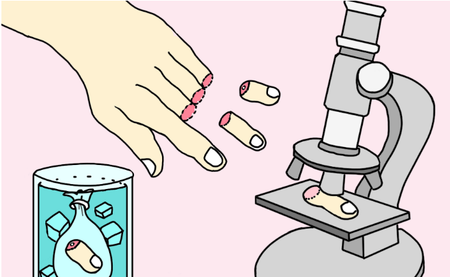 骨头,血管和筋尽断,11小时接断指!