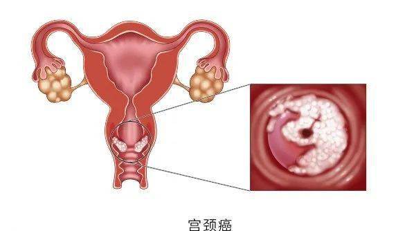 宫颈筛查tct报告单图片图片