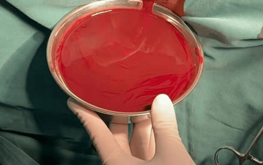 11岁小姑娘腹痛难忍,检查才知是这里的"膜"闭锁了_处女膜_子宫_阴道