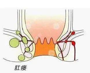 肠窦炎图片