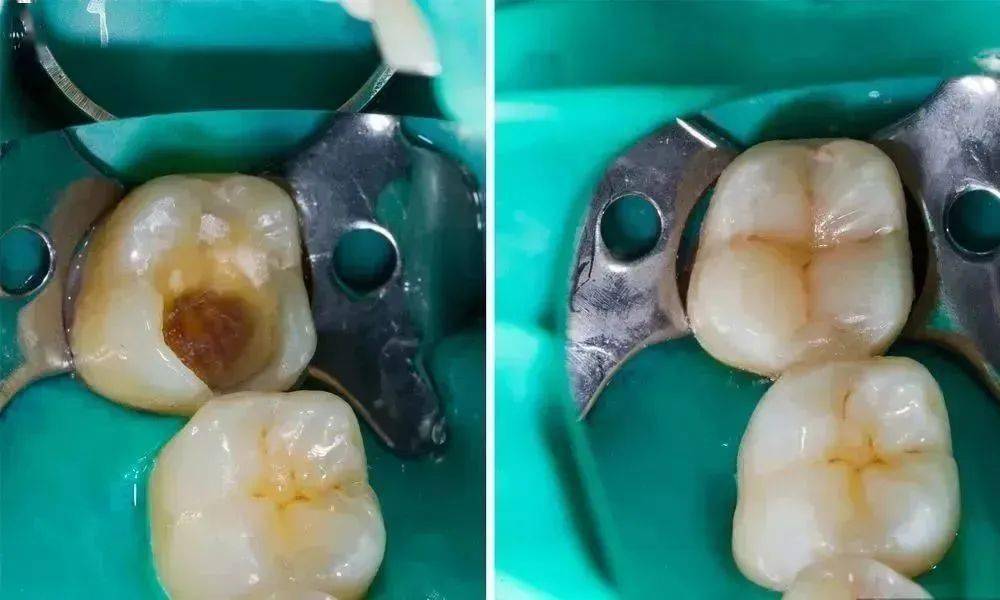 怀集人这里有免费补牙福利,赶紧看!_口腔_材料_牙齿