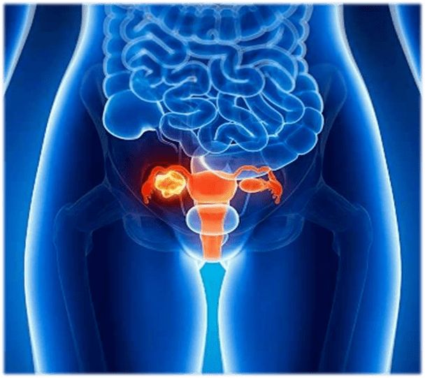 肿瘤防治周 | 远离"沉默的杀手"——卵巢癌_治疗_患者_进行