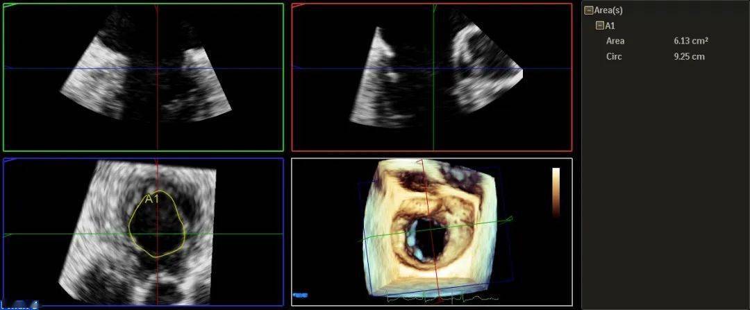 6mm,r=15mm, eroa= 1.