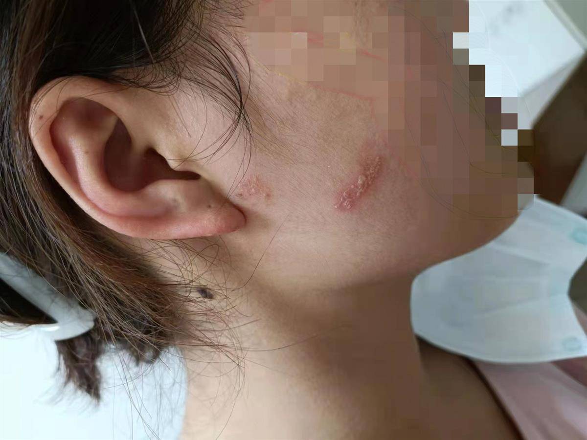 女子夜跑后脸"烂了"险毁容,竟因随手拍死了一只小虫