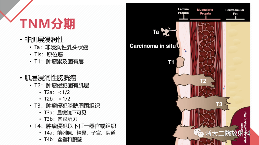 膀胱肿瘤及其亚型,肿瘤样病变:影像-病理_urinary_全网_of