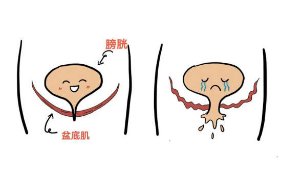 关注女性盆底肌松弛,远离"社交癌"_治疗_患者_压力