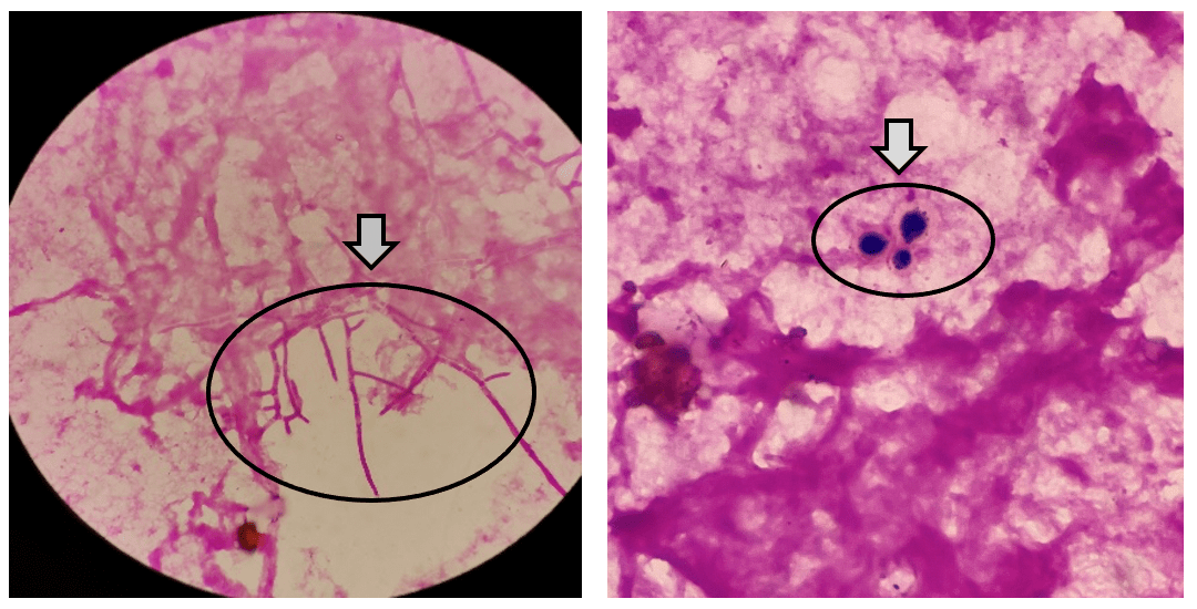 罕见68分享1例马尔尼菲篮状菌合并新型隐球菌双重真菌感染案例