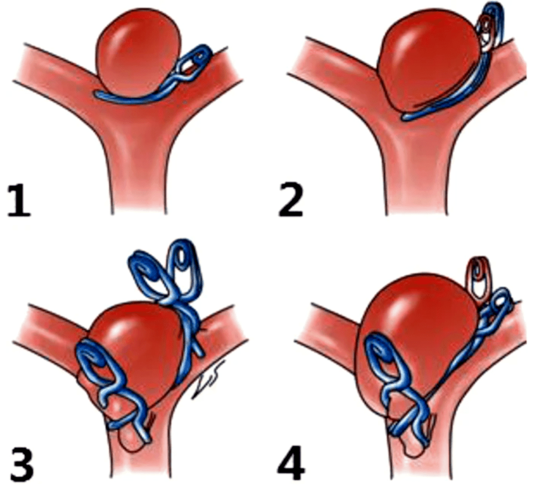 动脉瘤夹闭术是指通过开颅手术的方法对动脉瘤进行夹闭,使其隔绝于