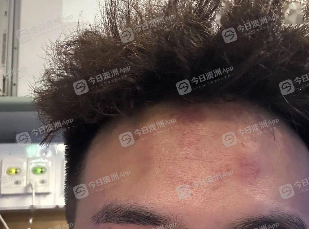 k额头淤青(图片来源:供图)k告诉记者,事发前并未与这伙青少年有任何