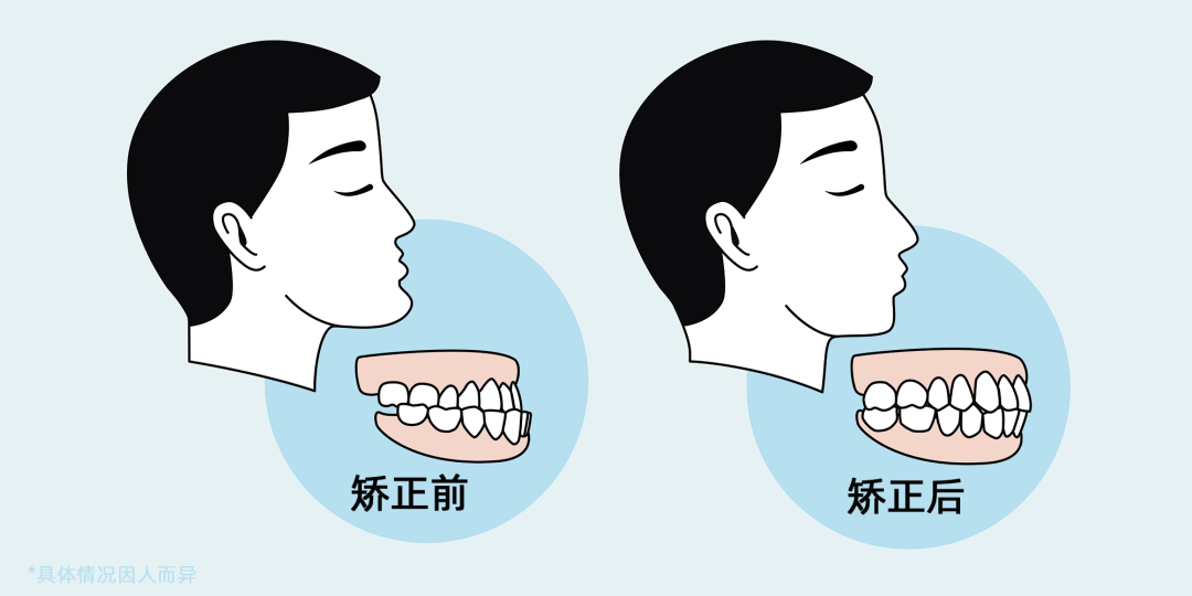 可能导致面部发育不均匀,下颌过度生长,引起咬合障碍等,看上去就像