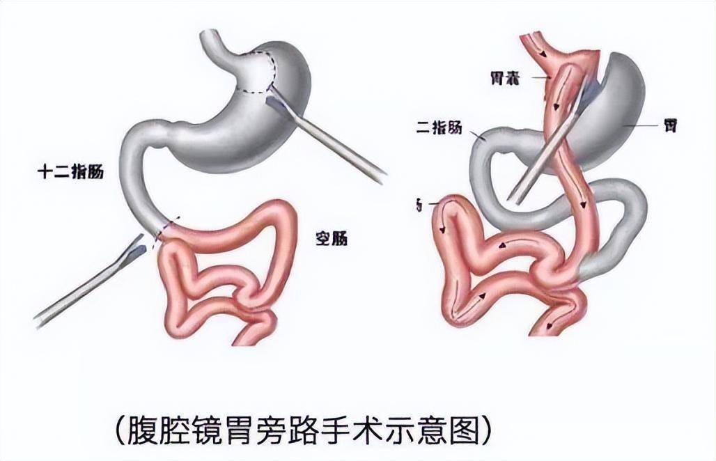 胃上部,胃食管结合部位隔离出一个15