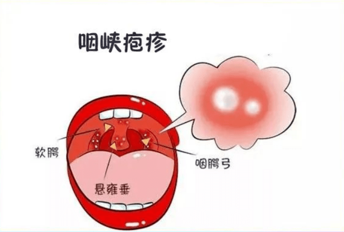 疱疹性咽峡炎常见临床症状为发热,咽痛,口腔疼痛,咽痛严重时可影响