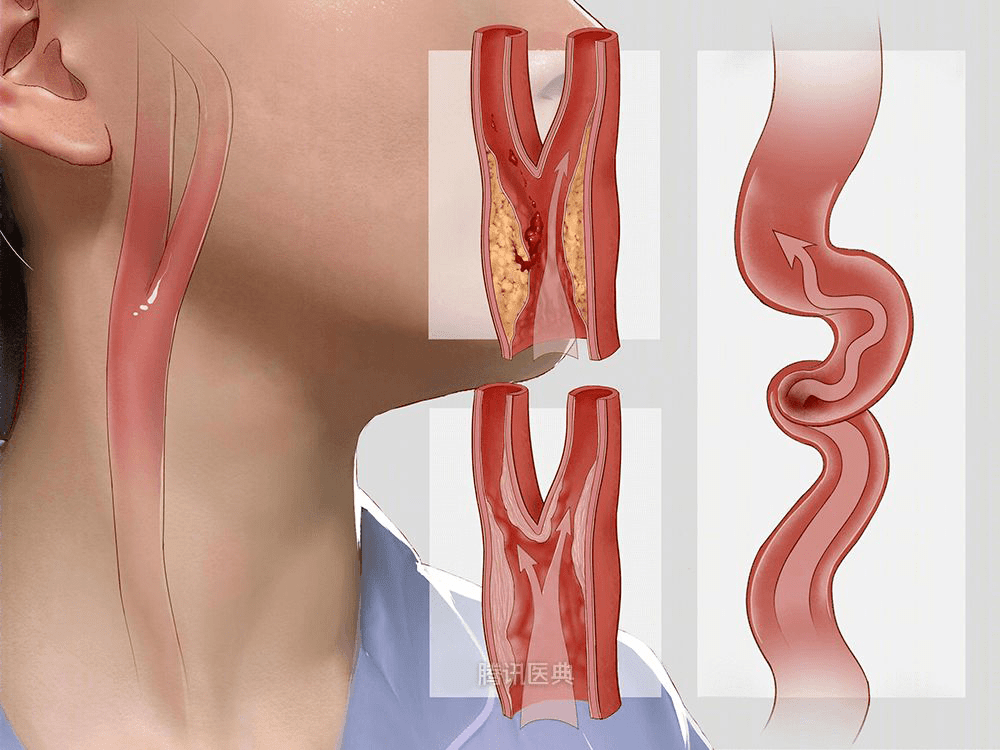 脖子大动脉图片