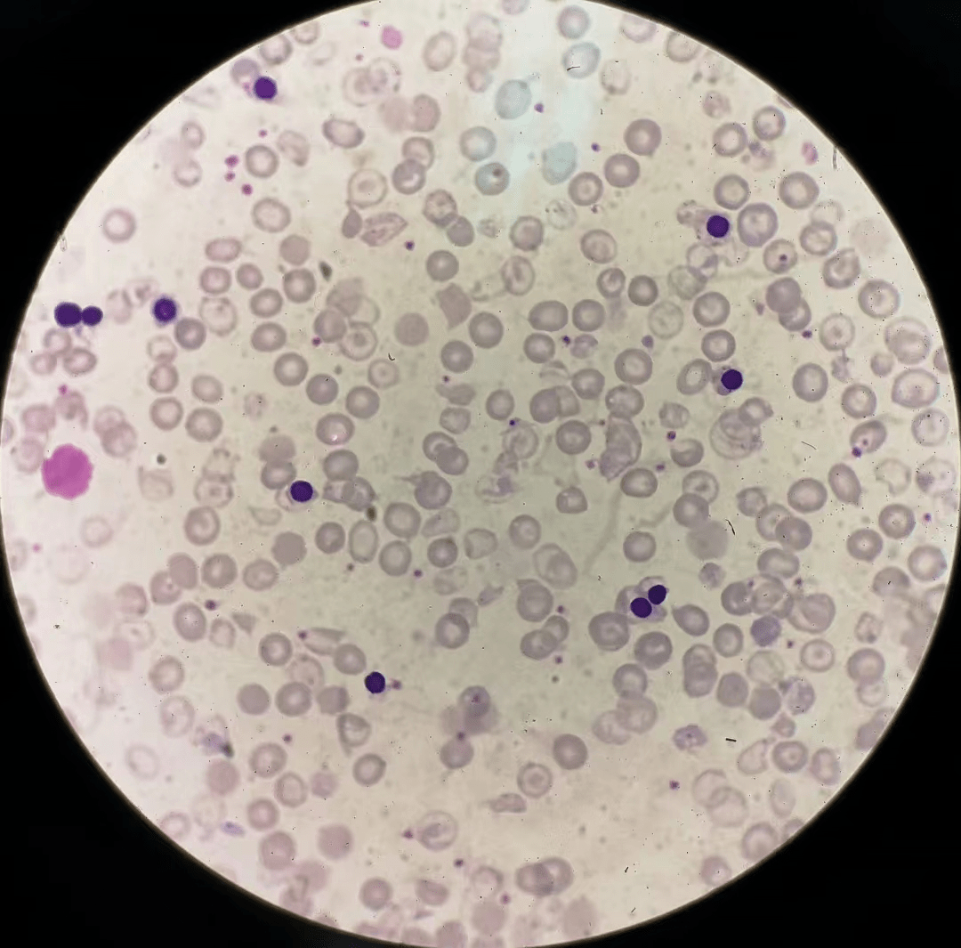 (地贫患者外周血涂片)血涂片镜检可见有核红细胞和网织红细胞增多;红