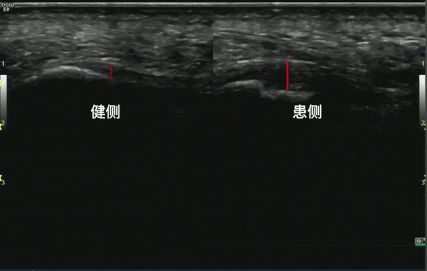 【迁医健康】行走的疼痛 足底筋膜炎_检查_超声_治疗