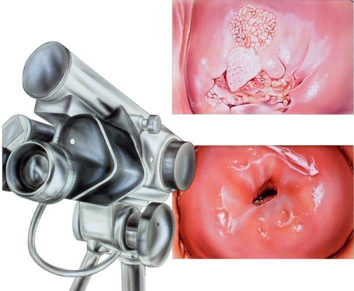 宫颈表面发黑图片图片