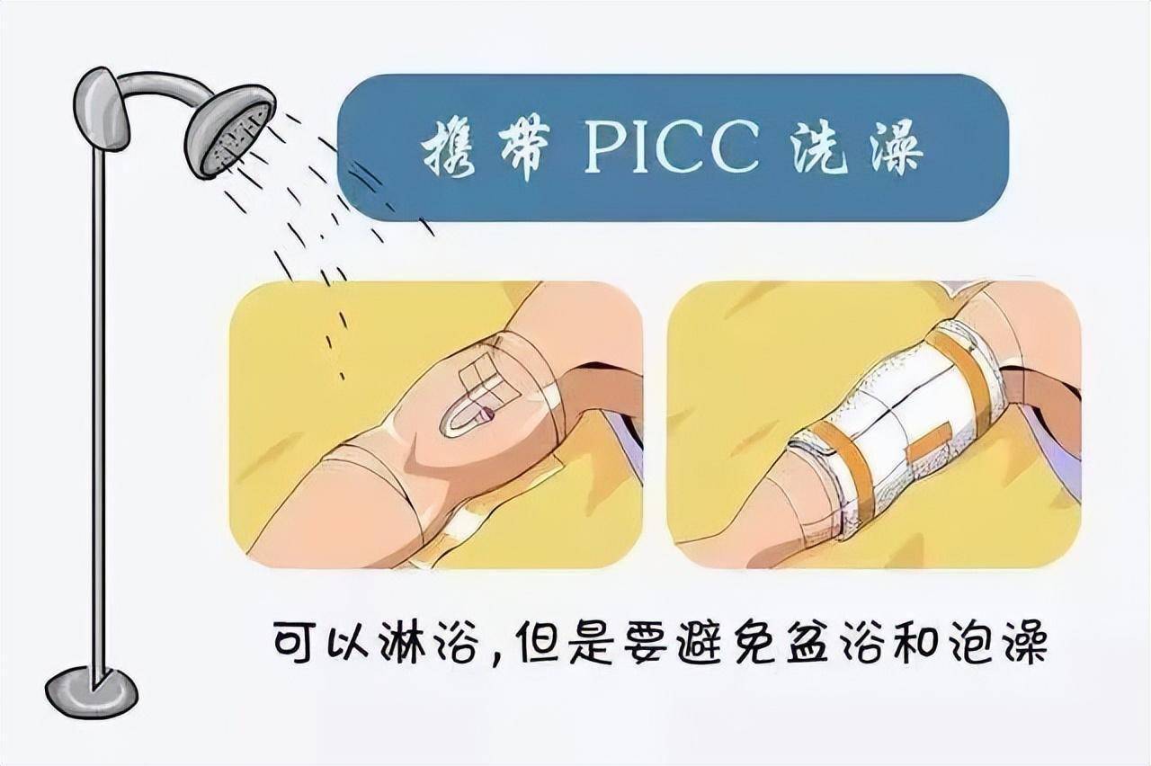 picc导管图片 卡通图片图片