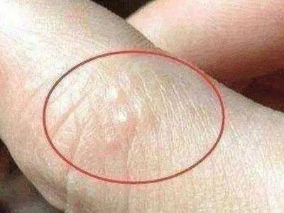 这是湿毒堆积!艾灸防治速效_皮肤_夏天_问题