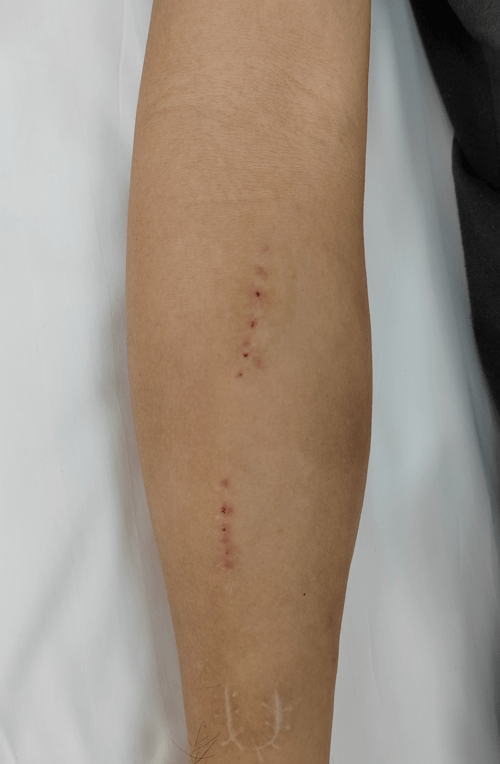 为保护透析患者"生命线" 他们想尽了办法