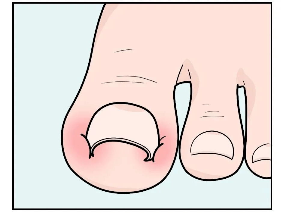 发展,指甲会把甲沟扎破,潜在细菌侵入,造成感染,红肿化脓,形成 甲沟炎