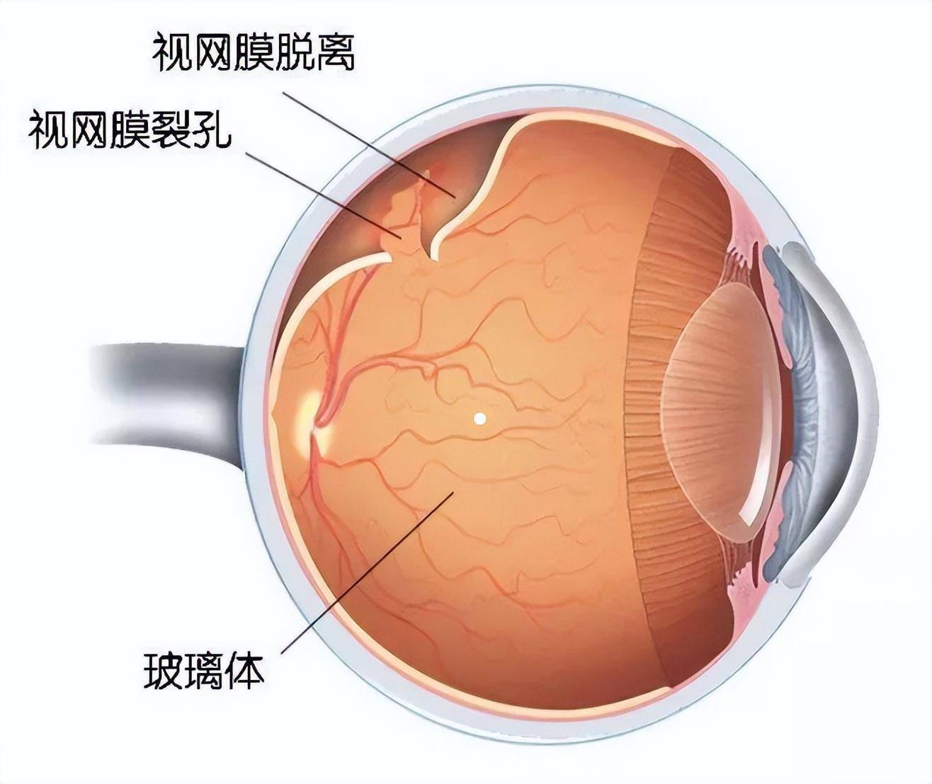 女孩近视1000多度欲做近视手术,检查时竟发现眼底破了个"洞"