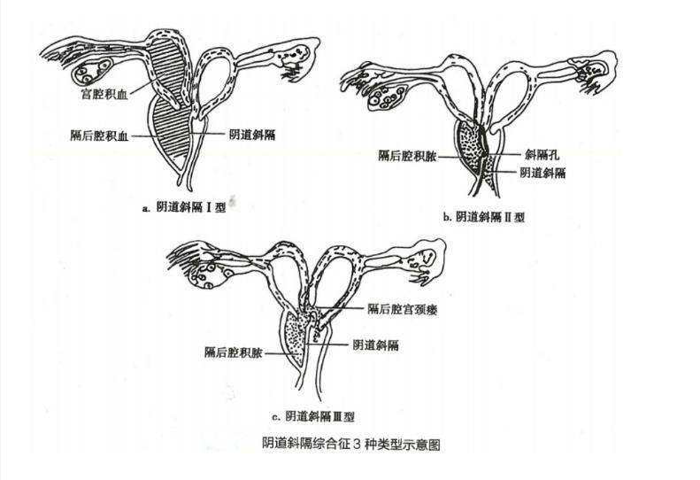 雙宮頸,雙子宮,雙陰道以及一側陰道完全或不完全閉鎖的先天性畸形問題