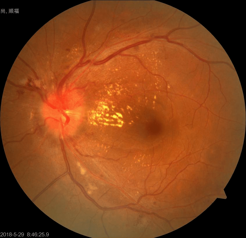眼底棉绒斑图片图片