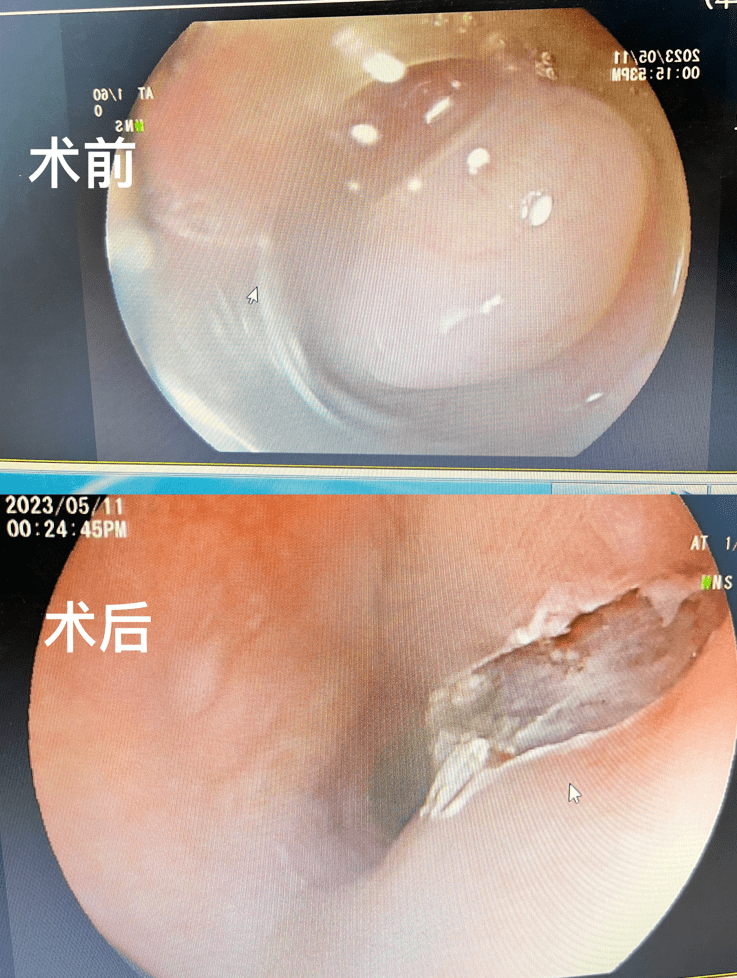 市一院完成首例食道平滑肌瘤胃镜下剥离术