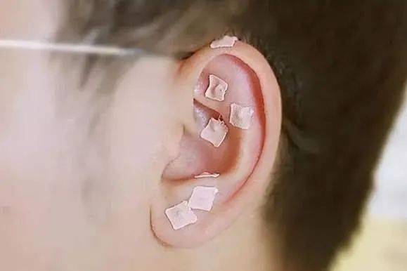 【健康养生】中医护理技术—耳穴压豆操作_治疗_疾病_功能