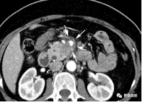 格艾選讀丨胰腺腫瘤圖例~_顯示_靜脈_腫塊
