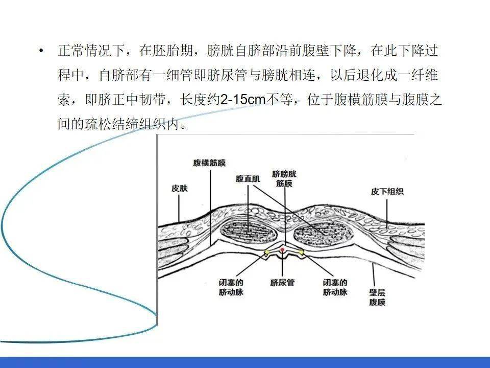 脐尿管囊肿女性图片