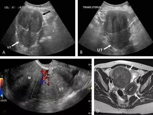 来点干货 子宫肌瘤的超声诊断和鉴别