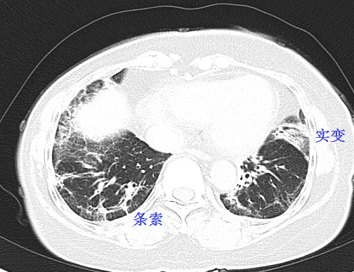 皮肌炎继发的间质性肺炎极易漏诊!从ct上怎么看?_患者_医生_胸膜