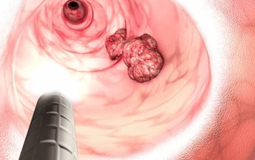 肛门癌的症状图片