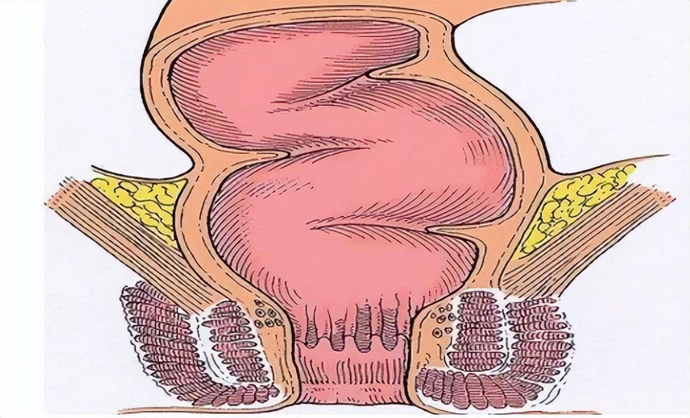 肛管癌痔疮图片