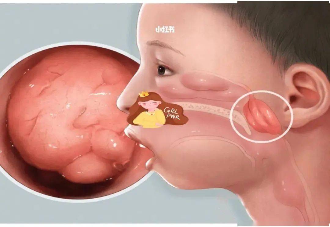 优惠仅对会员可见:腺样体肥大,过敏调理