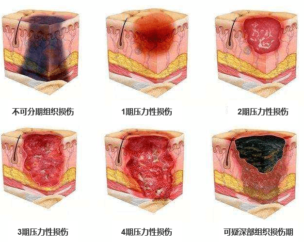 压疮处理