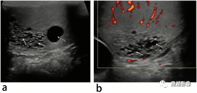 渔网状睾丸,小蛋蛋,睾丸微石症 男性不孕症患者的影像学表现