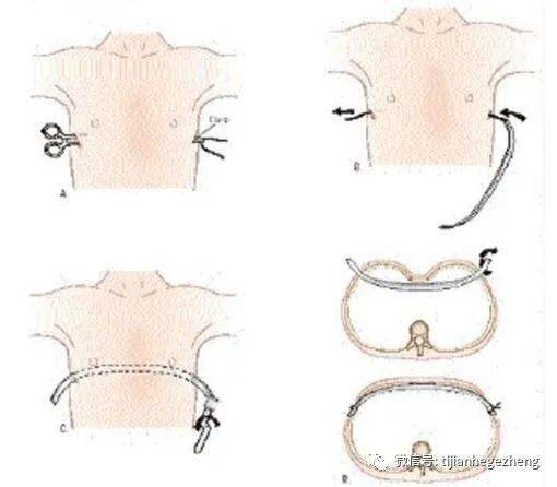 漏斗胸nuss术后可以参加招飞体检吗?_手术_畸形_胸骨