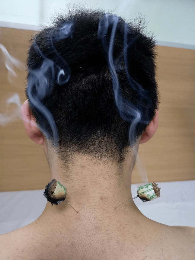 【市中医|冬病夏治】夏治三伏行针忙 针灸科冬病夏治开始了_治疗_疾病_穴位