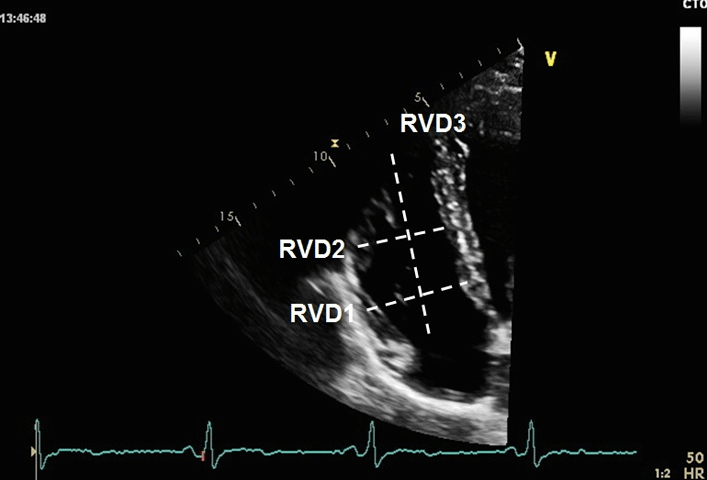 超声心动图评估肺动脉高压准不准?如何评估?_测量_患者_进行
