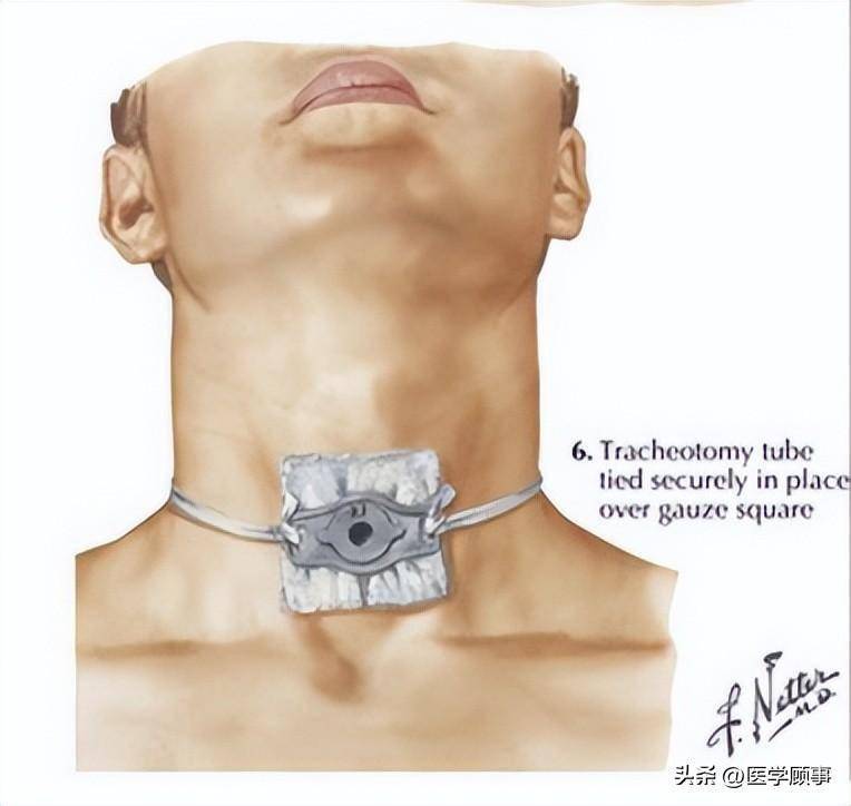 气管切开位置图图片