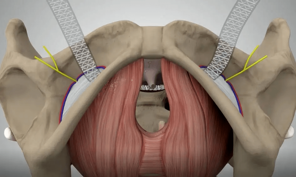 而对于重度压力性尿失禁患者或者保守治疗无效的患者,可以考虑手术