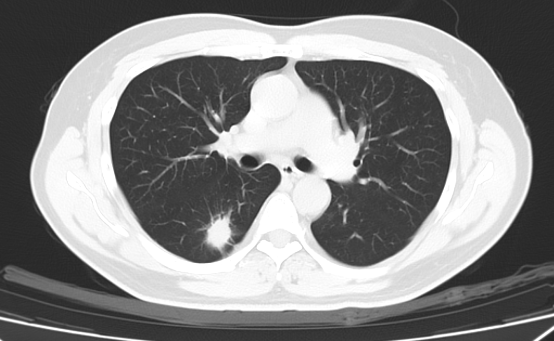放射科:肺癌早筛非ct检查莫属!【医生手记】